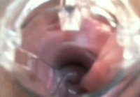 Inserted a dilator into the pussy and conducts a gynecology lesson